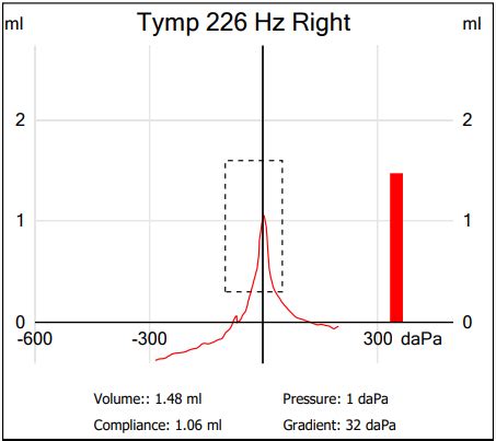 Tympanometry: What It Is and Types of Tympanogram Readings.